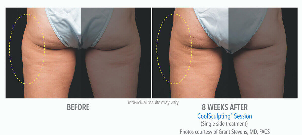 coolsculpting new jersey
